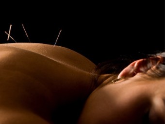 Treating Neurological Conditions With Neuro-Acupuncture